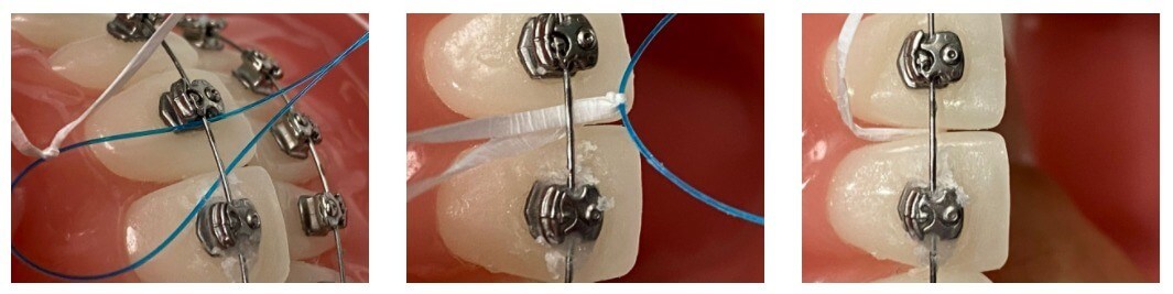 flossing-1