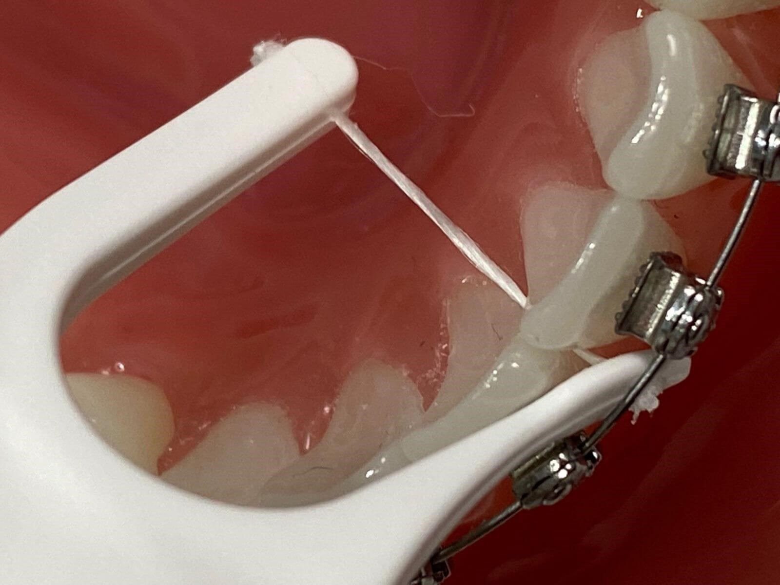 flossing-2