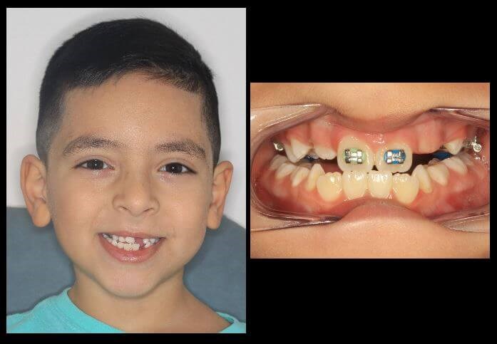 Child Orthodontics