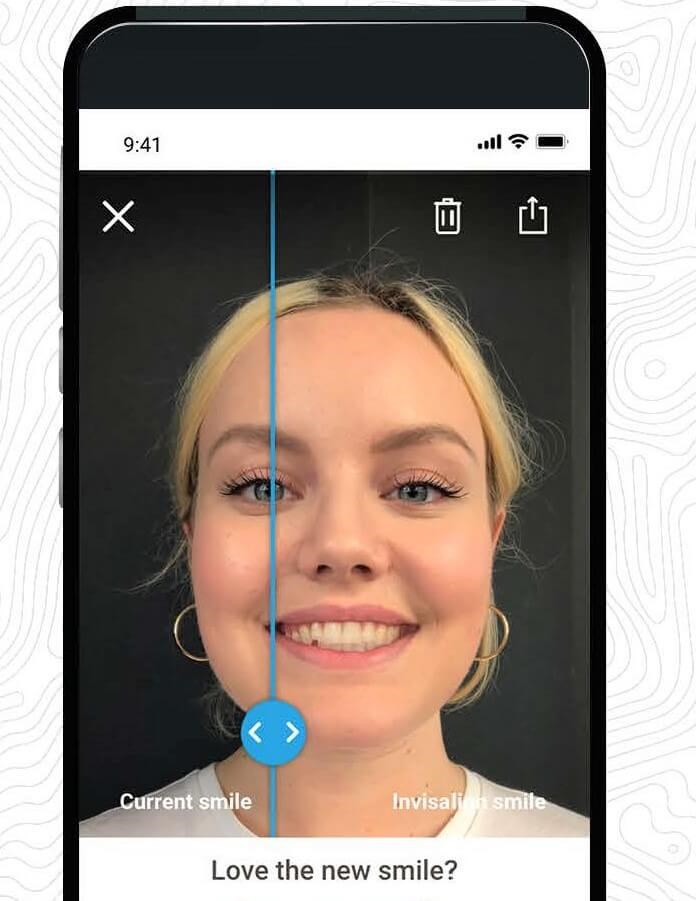 Invisalign Phone App
