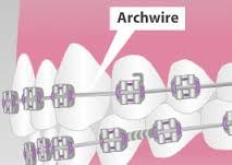 Archwire